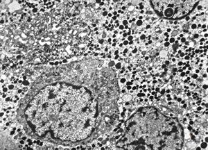 M, 23y. | acidophilic pituitary adenoma (STH)